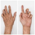 Ulnar claw hand of Asian elder man. also known as `spinster`s claw