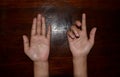 Ulnar claw hand of Asian young woman. also known as `spinster`s claw