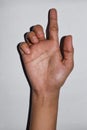 Ulnar claw hand of Asian young woman. also known as `spinster`s claw