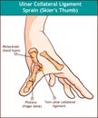 Ulnar Collateral Ligament Sprain Skier`s Thumb