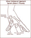 Ulnar Collateral Ligament Sprain Skier`s Thumb