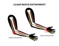 Ulnar nerve entrapment