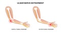 Ulnar nerve entrapment