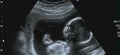 Ultrasonography Analysis of a 4th Month Fetus