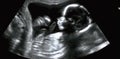 Ultrasonography Analysis of a 4th Month Fetus