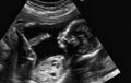 Ultrasonography Analysis of a 4th Month Fetus