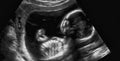 Ultrasonography Analysis of a 4th Month Fetus