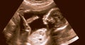 Ultrasonography Analysis of a 4th Month Fetus