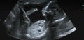 Ultrasonography Analysis of a 4th Month Fetus