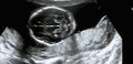 Ultrasonography Analysis of a 4th Month Fetus