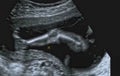 Ultrasonography Analysis of a 4th Month Fetus