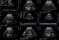 Ultrasonography fetus pictures