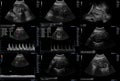 Ultrasonography fetus pictures