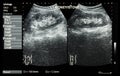 Ultrasonography of kidney : show left kidney stone ( 2 image for compare ) Royalty Free Stock Photo
