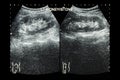 Ultrasonography of kidney : show left kidney stone ( 2 image for compare ) Royalty Free Stock Photo