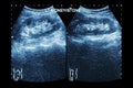 Ultrasonography of kidney : show left kidney stone ( 2 image for compare ) Royalty Free Stock Photo