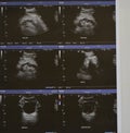 Ultrasonography of the upper abdomen with visualized portions of various organs