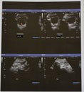 Ultrasonography of the upper abdomen with visualized portions of various organs. Translation