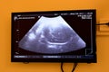 Ultrasonography on the uterus of a pregnant woman showing a healthy fetus, maternal ultrasound during pregnancy, pregnancy follow