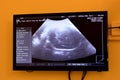 Ultrasonography on the uterus of a pregnant woman showing a healthy fetus, maternal ultrasound during pregnancy, pregnancy follow