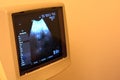 Ultrasonography on the uterus of a pregnant woman showing a healthy fetus, maternal ultrasound during pregnancy, pregnancy follow