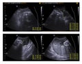 Ultrasound abdomen.Ultrasound scan medical imaging of abdomen diagnosing