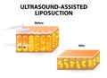 Ultrasound-assisted liposuction Royalty Free Stock Photo