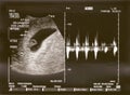 Ultrasound baby Royalty Free Stock Photo