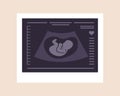 Ultrasound of baby. Embryo in womb. Pregnancy screening. Baby health diagnostic. Fetus silhouette photo. Sonography or