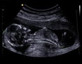 Ultrazvuk dítě 