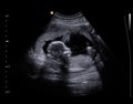 Ultrasound Baby Royalty Free Stock Photo
