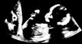 Ultrasound of baby inside mother's womb. Ultrasonography, echography of pregnant woman. Maternity and pregnancy concept