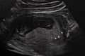 Ultrasound of baby in mother Royalty Free Stock Photo
