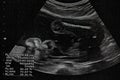 Ultrasound of baby in mother Royalty Free Stock Photo