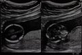 Ultrasound of baby in mother Royalty Free Stock Photo