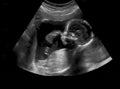 Ultrasound of baby in mother's womb