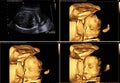 Ultrasound of baby in mother`s womb. Royalty Free Stock Photo