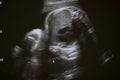 Ultrasound photo of unborn baby in mother`s womb, closeup view Royalty Free Stock Photo