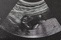 Ultrasound of baby in mother Royalty Free Stock Photo