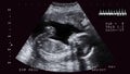 ultrasound baby screen animation footage