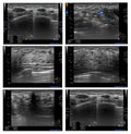 Ultrasound Breast a Female 34 year old