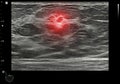 ultrasound breast of Patient after mammogram for diagnonsis Breast cancer in women isolated on black background