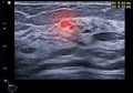 ultrasound breast of Patient after mammogram for diagnonsis Breast cancer in women isolated on black background