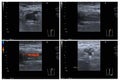 Ultrasound color doppler both leg.