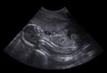 Ultrasound diagnosis of pregnant women