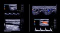 Ultrasound doppler for finding deep vein thrombosis.