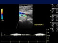 Ultrasound doppler of popliteal vien for finding deep vein thrombosis. Royalty Free Stock Photo