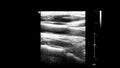 Ultrasound examination of blood vessels in grayscale mode. Royalty Free Stock Photo