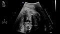 Ultrasound examination of the fetal heart