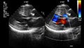 Image of the heart during transesophageal ultrasound.